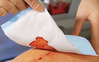 Après une chirurgie d'agrandissement du pénis, il est nécessaire de faire des bandages. 