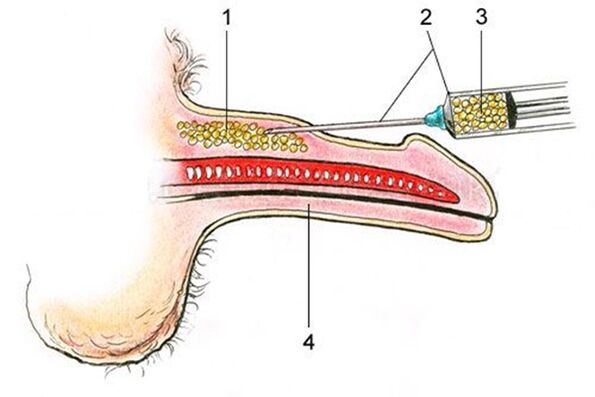 Lipofilling - l'introduction de tissu adipeux dans la tige du pénis