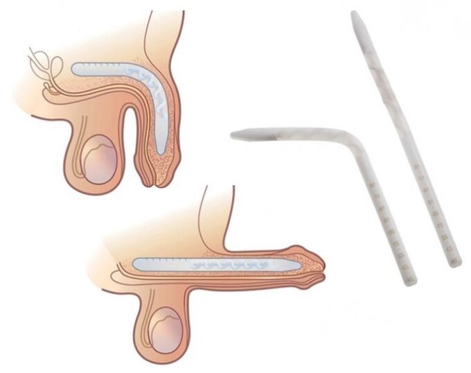 Falloplastie pour augmenter un membre