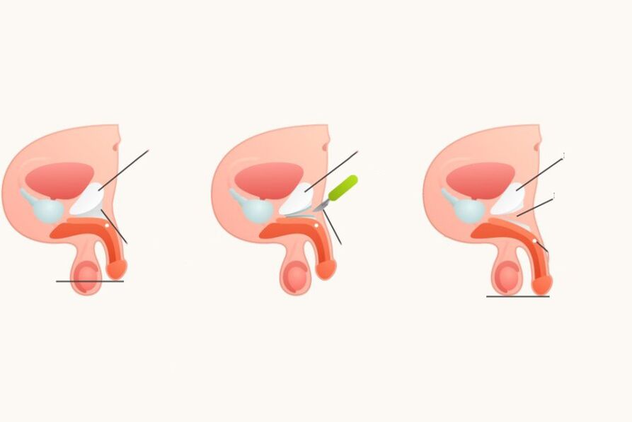 Ligamentomotomie pour augmenter le pénis