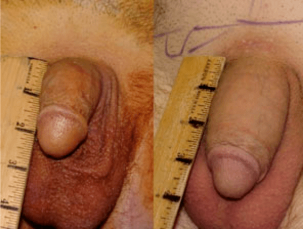 Avant et après lipofilling et implantation de gel.